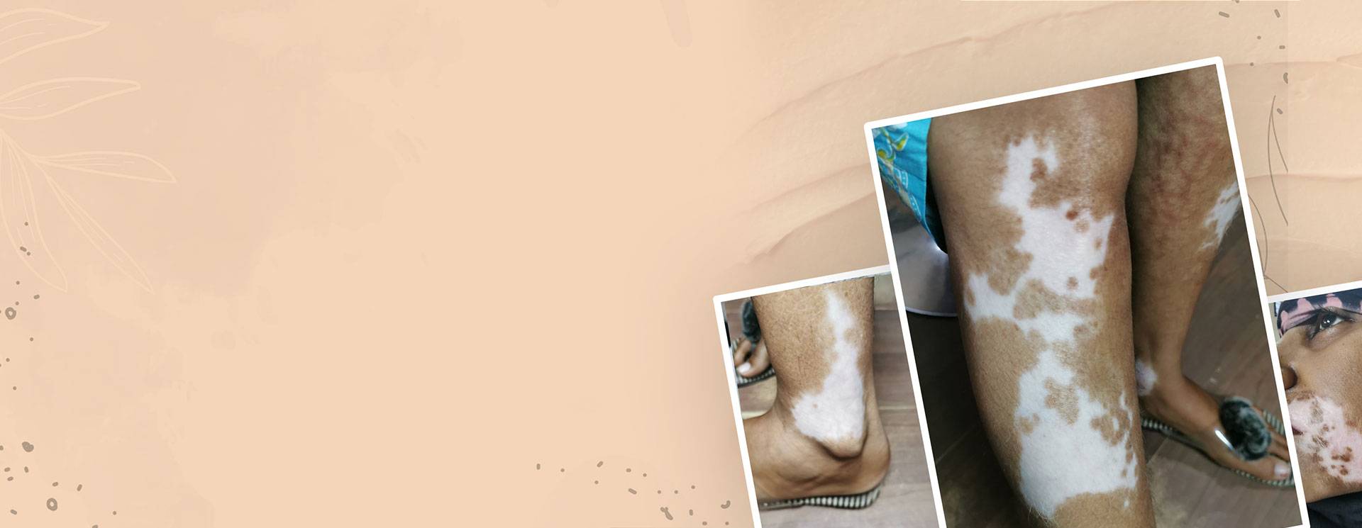 Skin Treatment Lucknow