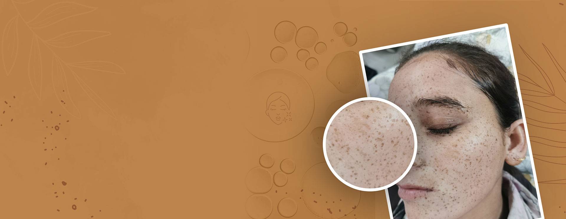 Skin Treatment Lucknow