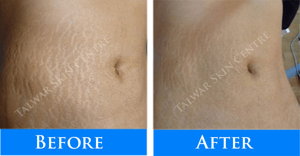 1stretch-mark-reduction