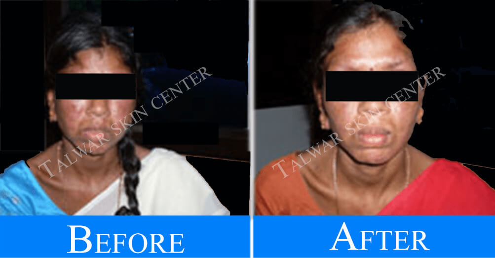 Urticaria-before-after