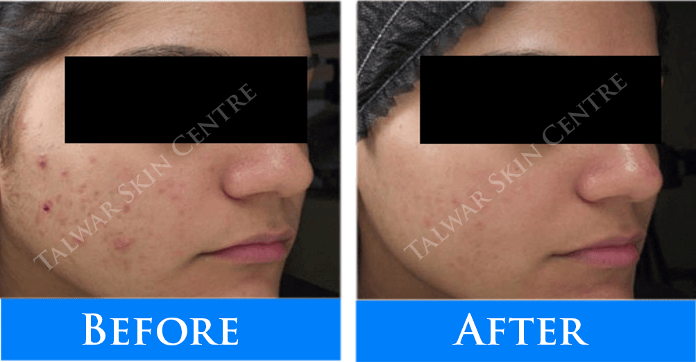 acne_before-after