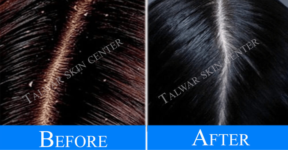 dandruff-before-after