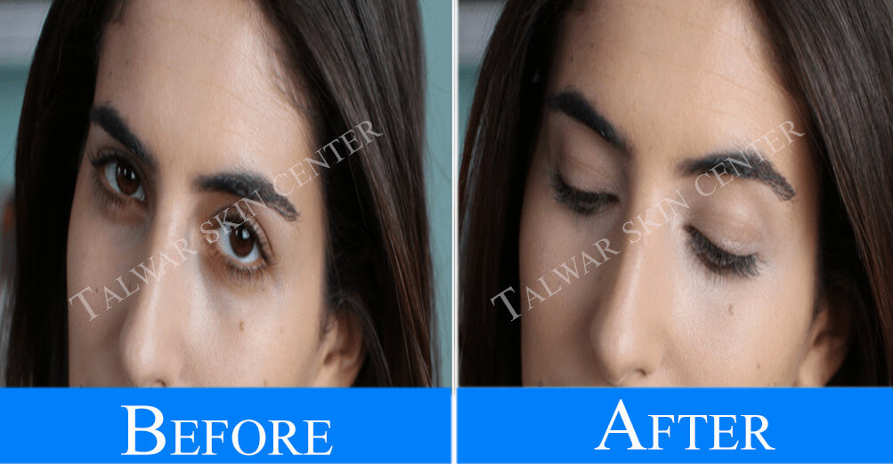 dark-circles-before-after