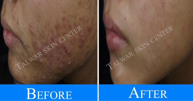 Skin treatment Lucknow
