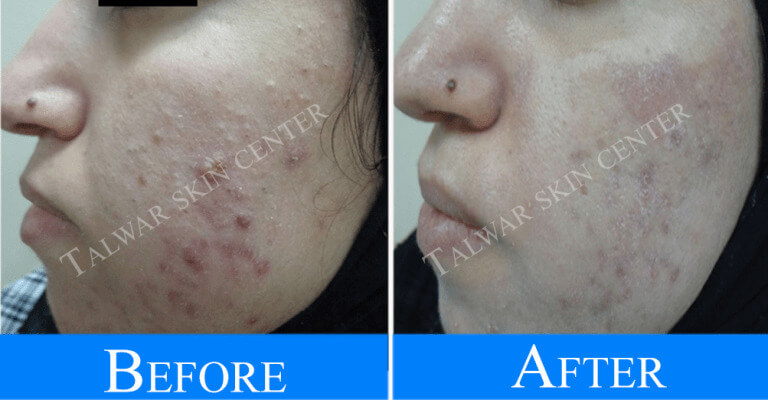 Skin treatment Lucknow