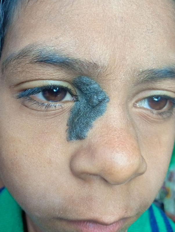 skin treatment