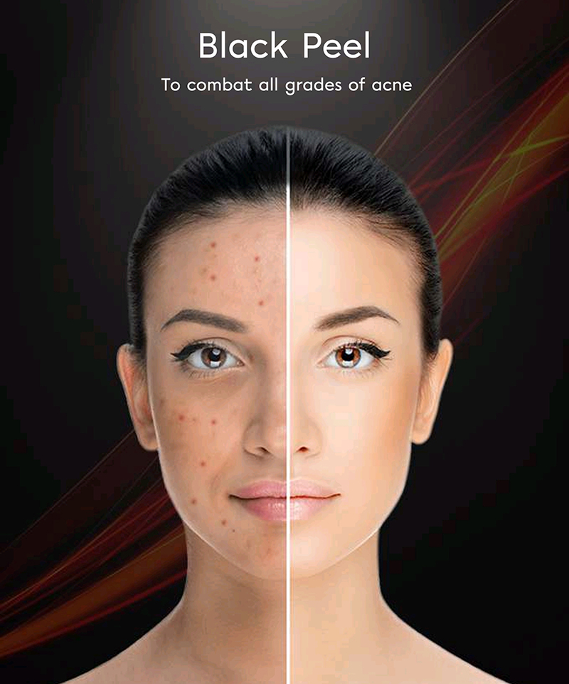 anti-acne