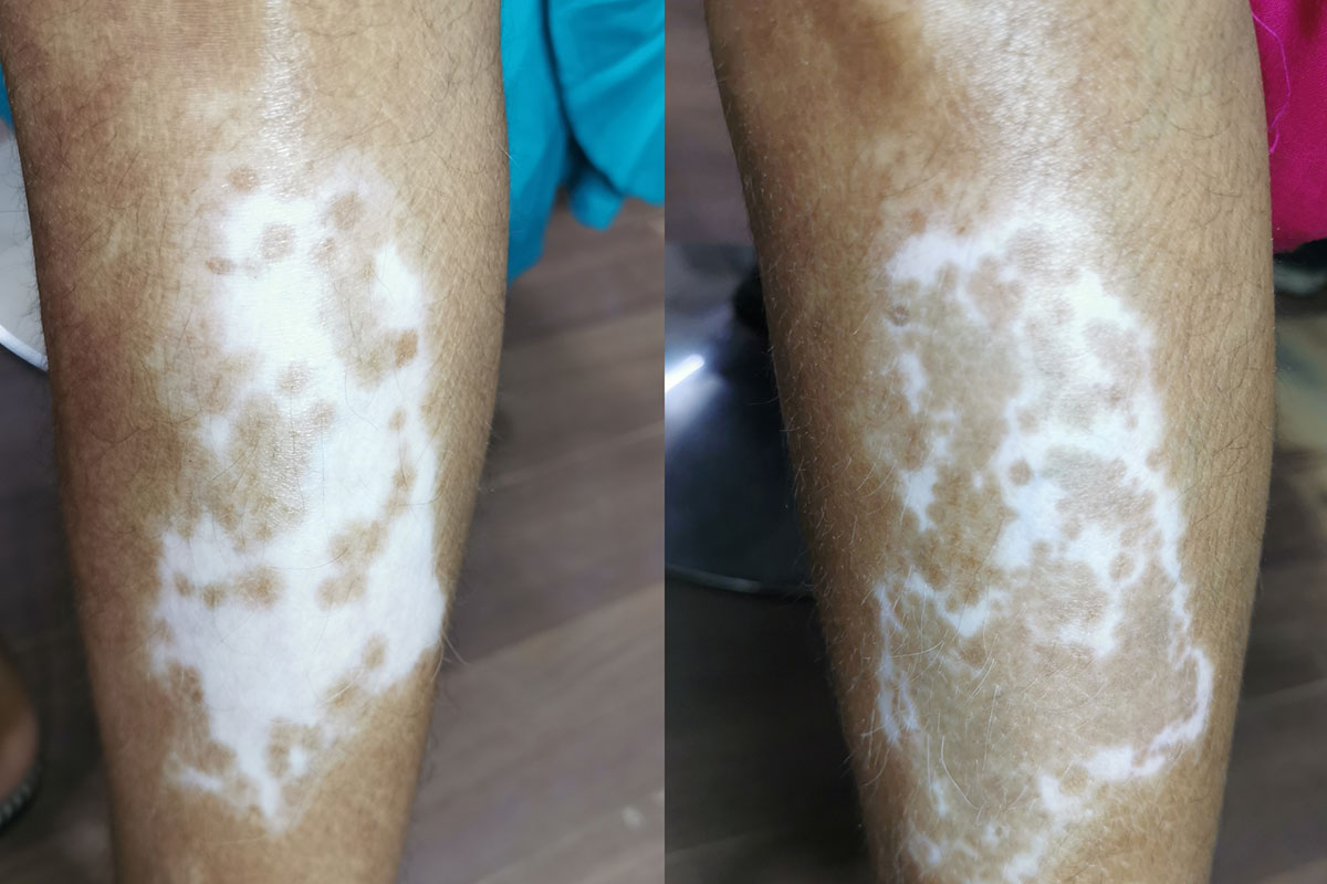 vitiligo_treatment