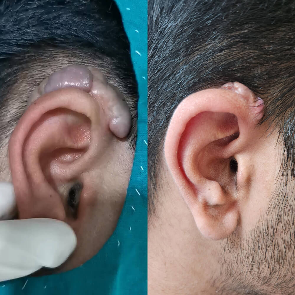 Scar_Reduction_Laser_process