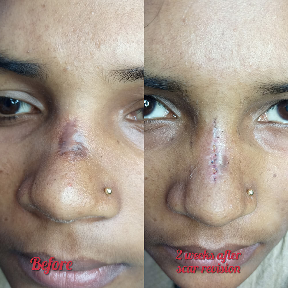 Scar_Reduction_Laser_process