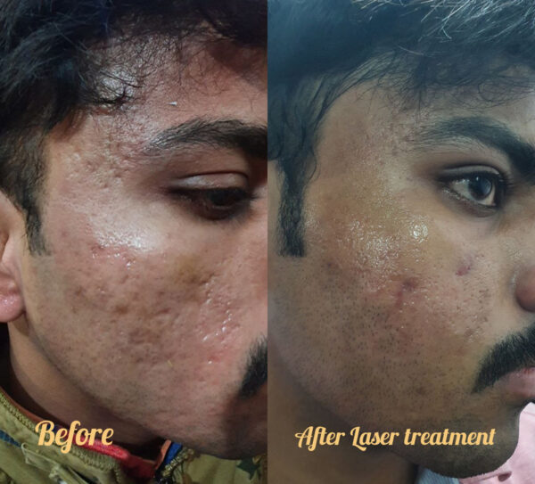 Scar_Reduction_Laser_process