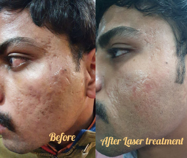 Scar_Reduction_Laser_process