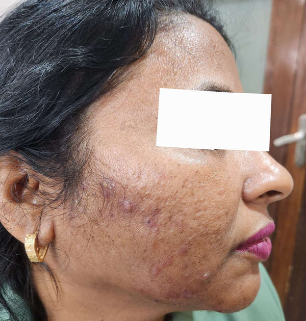 acne_treatment