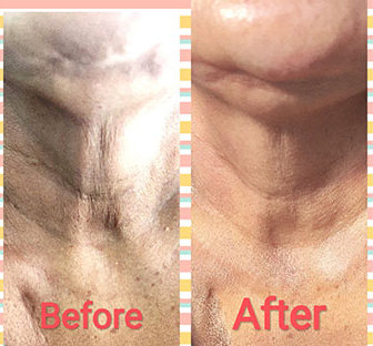 Skin tightening