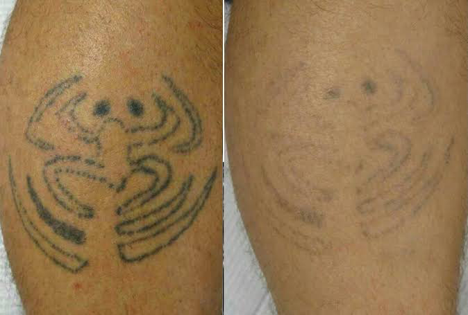 Laser Tattoo Removal